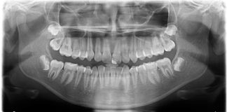 Ортопантомограмма зубов – для чего нужен панорамный снимок Ортопантомограмма зубов – для чего нужен панорамный снимок