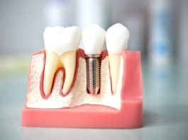 Протезирование зубов Протезирование зубов