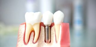 Протезирование зубов Протезирование зубов