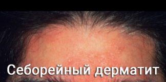 Шелушатся брови и кожи над бровями на лбу: причины и что делать