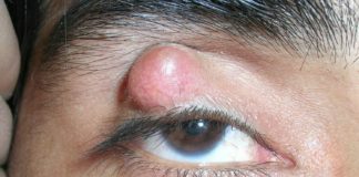 О шишке на брови под кожей: опухшая бровь над глазом у взрослого, герпес