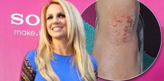 10 звезд с заметными дефектами внешности, которые не смогли помешать их карьере