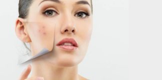 Прыщи на лице по зонам: причины возникновения и особенности лечения