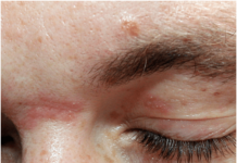 Выскакивают прыщи и шишки в области бровей: о чем говорит симптом, профилактика и лечение народными и медицинскими средствами