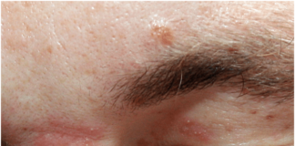 Выскакивают прыщи и шишки в области бровей: о чем говорит симптом, профилактика и лечение народными и медицинскими средствами