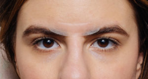 Как убрать морщину между бровями