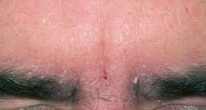 Почему шелушится кожа между и под бровями — причины и лечение кожи бровей