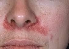 Как лечить себорейный дерматит на лице: фото, симптомы и лечение на дому