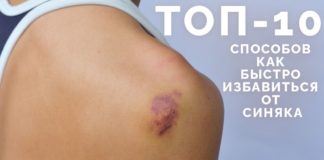 Как быстро избавиться от синяка: эффективные средства