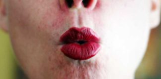 Герпес на лице: как лечить, причины, симптомы (фото)