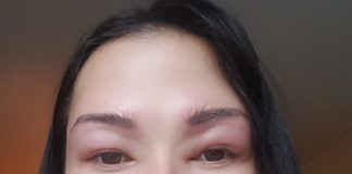 Гематома, ушиб или синяк на брови — что делать, чтобы скрыть и вылечить?