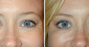 Ботокс: последствия, противопоказания, сколько держится, что нельзя делать после процедуры, маски вместо ботекса, Азбука здоровья