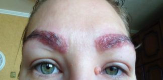 Аллергия на Перманентный Макияж Бровей – Признаки, Лечение, Предупреждение