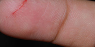 Как остановить кровь при рассечении