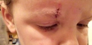 Рассечение брови у ребенка – что делать, чем обработать