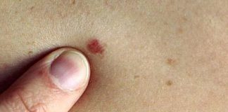 Посчитай родинки и узнаешь о человеке все