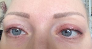 Отек после татуажа век и бровей: через сколько проходит и как снять побочный эффект с глаз