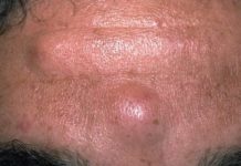 Шишка на брови