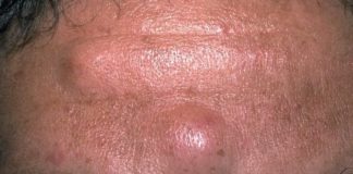 Шишка на брови