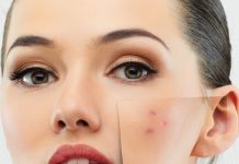 Причины появления прыщей и советы по профилактике