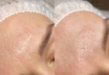 Как татуаж растяжек может помочь скрыть ваши комплексные зоны