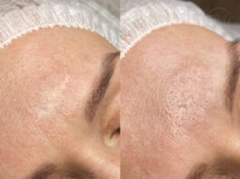 Как татуаж растяжек может помочь скрыть ваши комплексные зоны