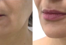 Современные технологии омоложения: особенности SMAS-лифтинга на аппарате Ultraformer