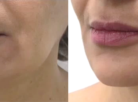 Современные технологии омоложения: особенности SMAS-лифтинга на аппарате Ultraformer